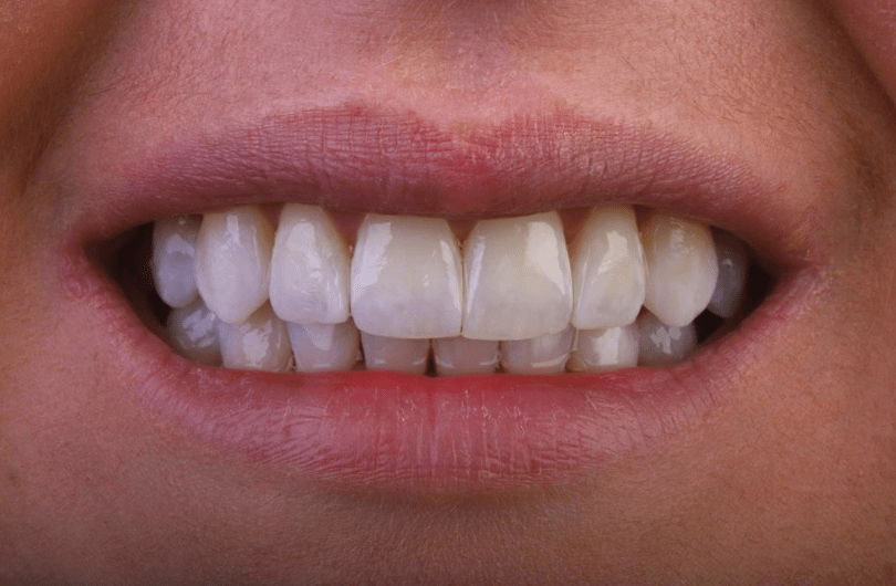 Teeth Whitening Dental Rituals Dentist in Gildersome, Leeds