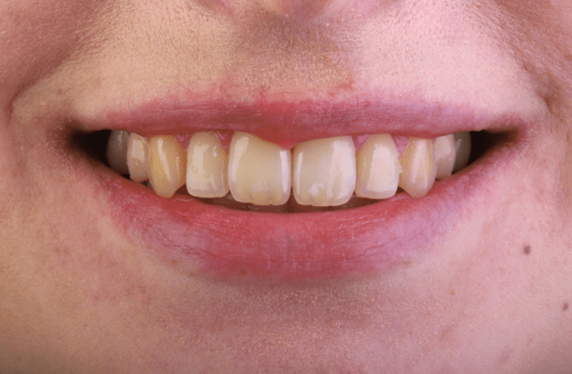 Teeth Whitening Dental Rituals Dentist in Gildersome, Leeds