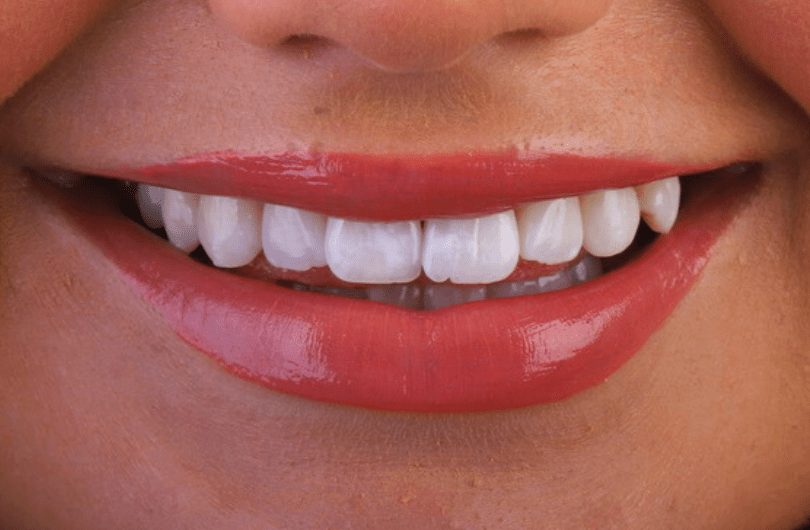 Teeth Whitening Dental Rituals Dentist in Gildersome, Leeds