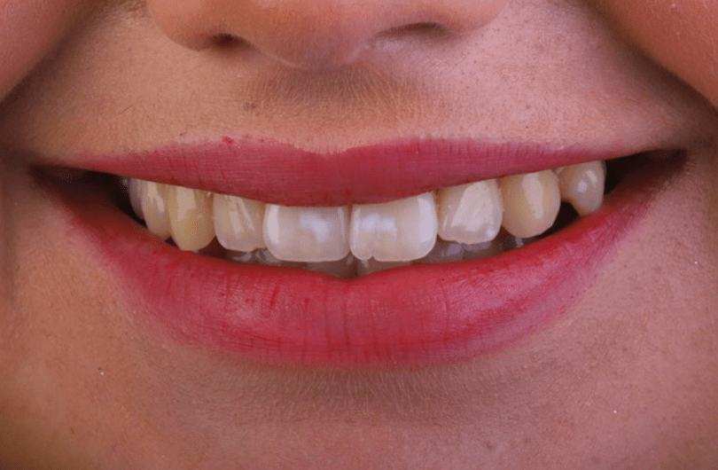 Teeth Whitening Dental Rituals Dentist in Gildersome, Leeds